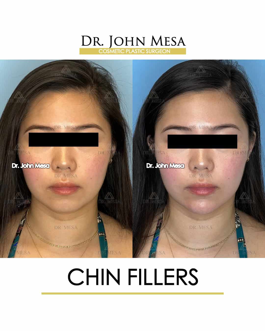 chin fillers results photos