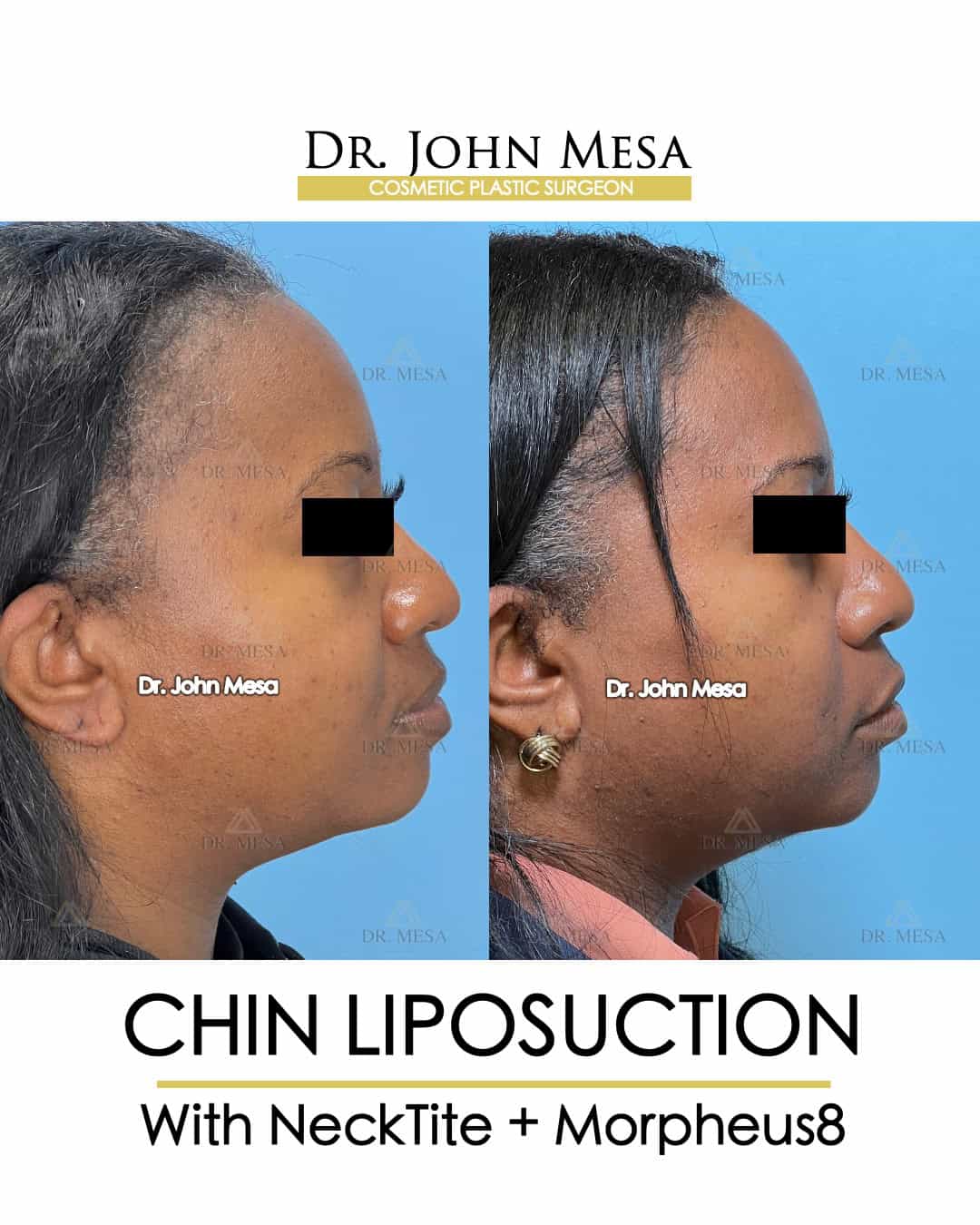 Chin Lipo NYC Doctor