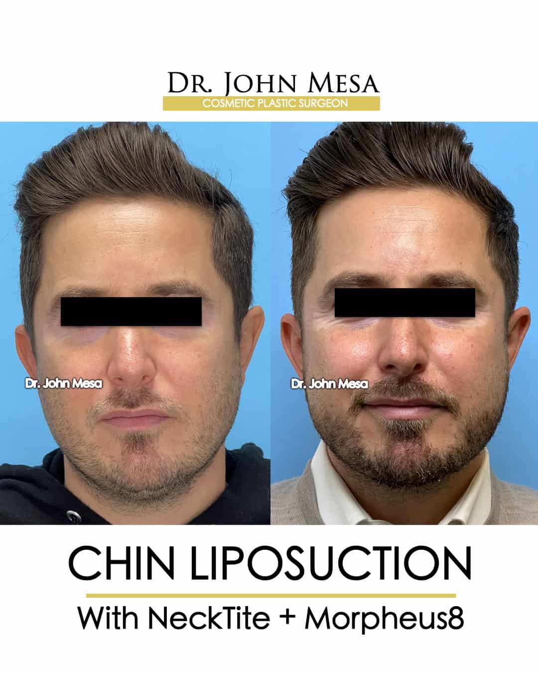 best chin liposuction nyc