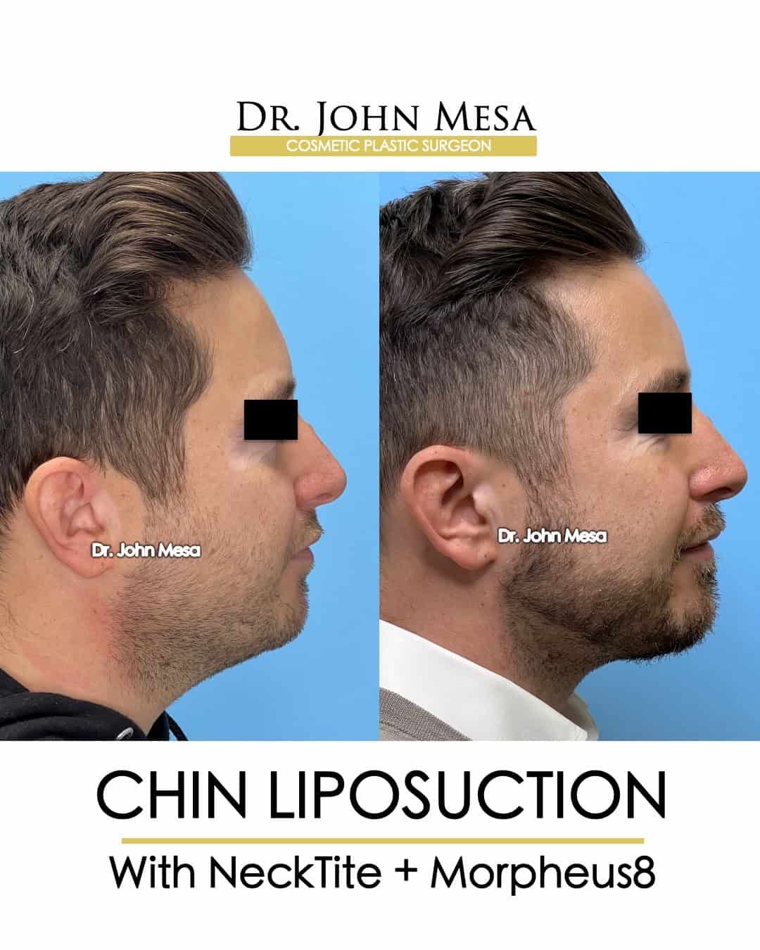 best chin liposuction surgery for men near me