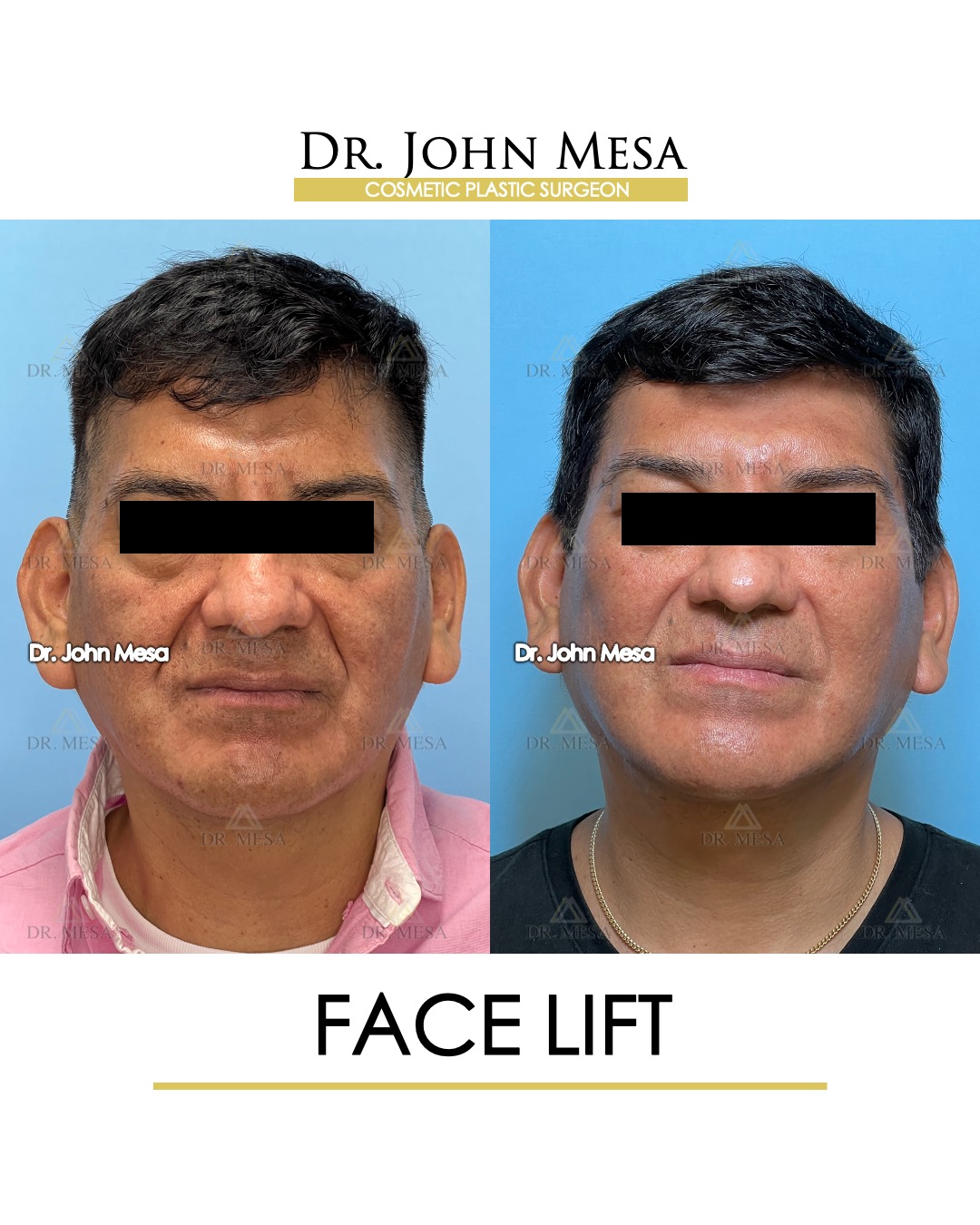 face lift doctor near me