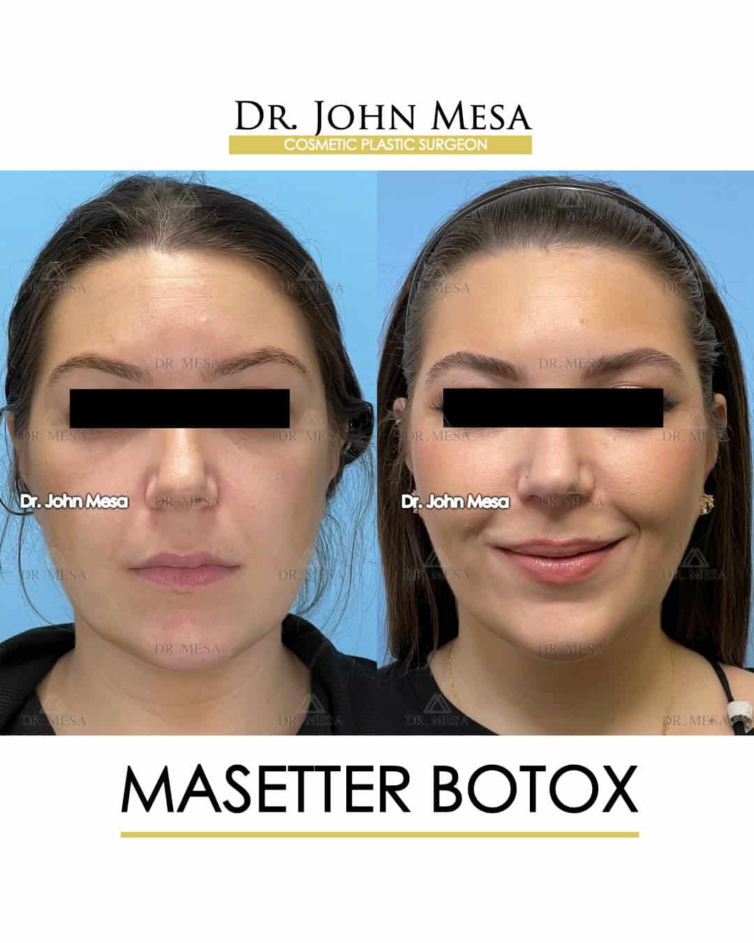 masseter botox before and after nyc