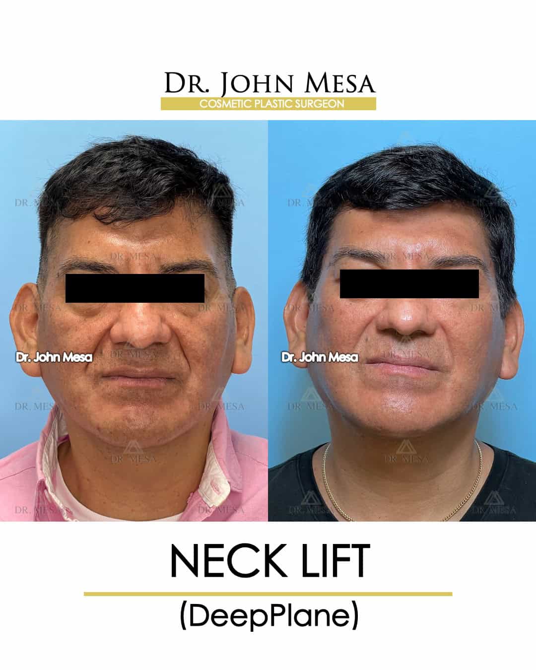 what is neck lift
