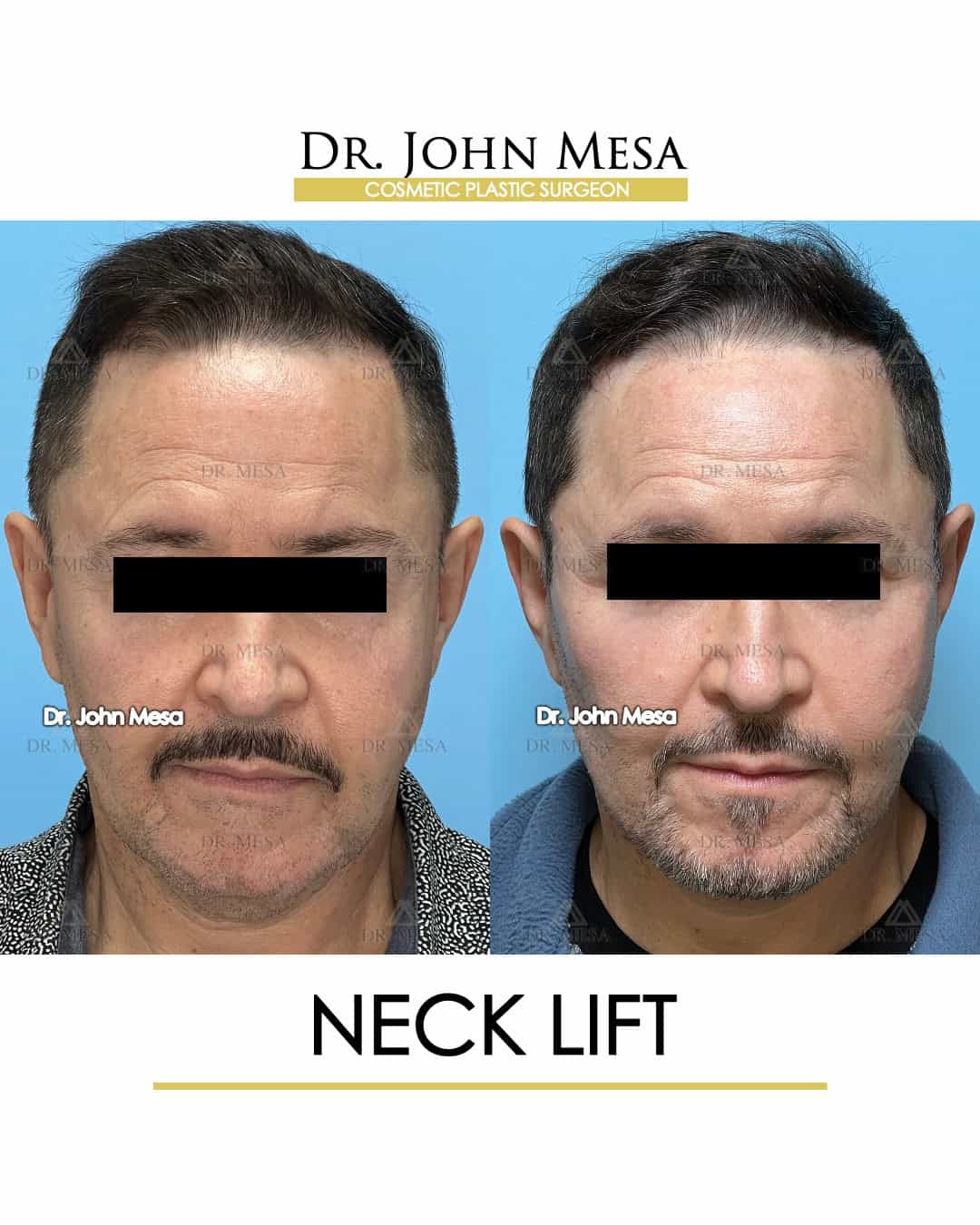 neck lift cost near me