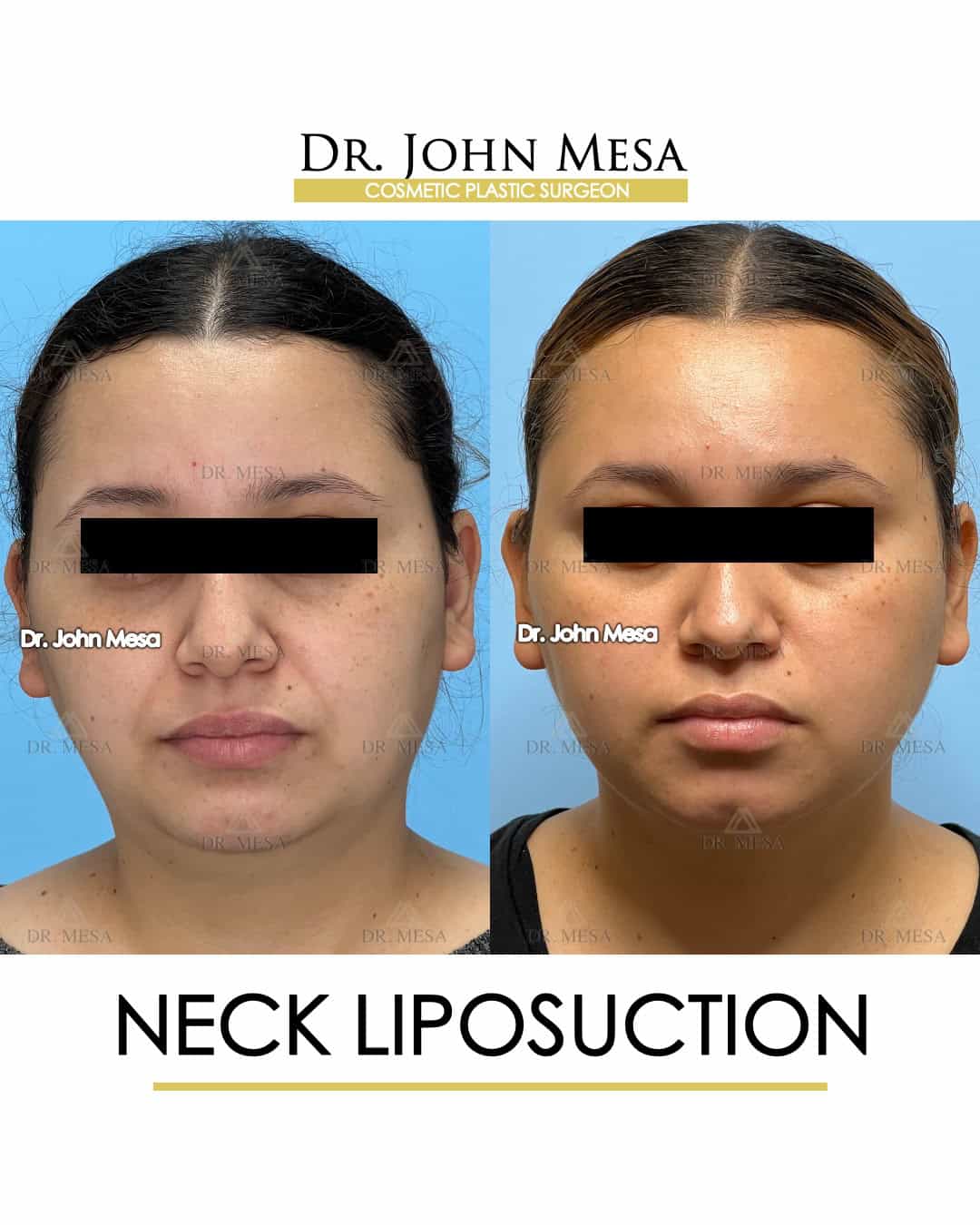 Neck Liposuction NYC