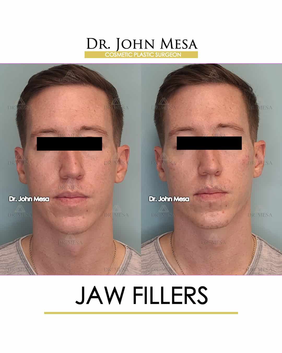 jaw fillers before and after photos