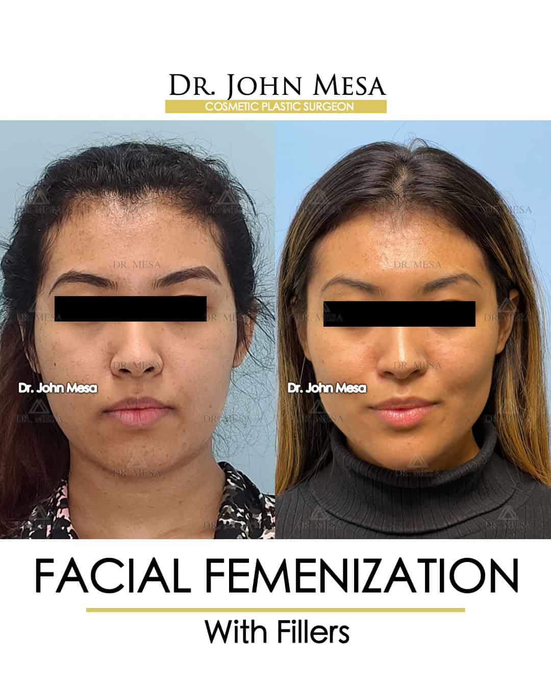 facial feminization doctor near me