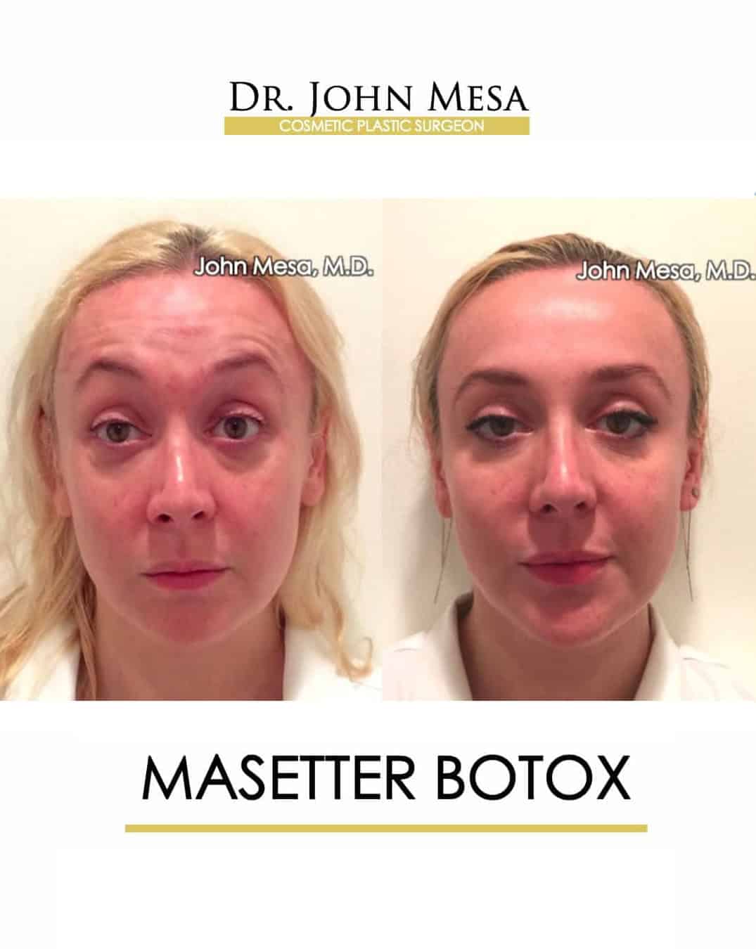 Masetter Botox NYC