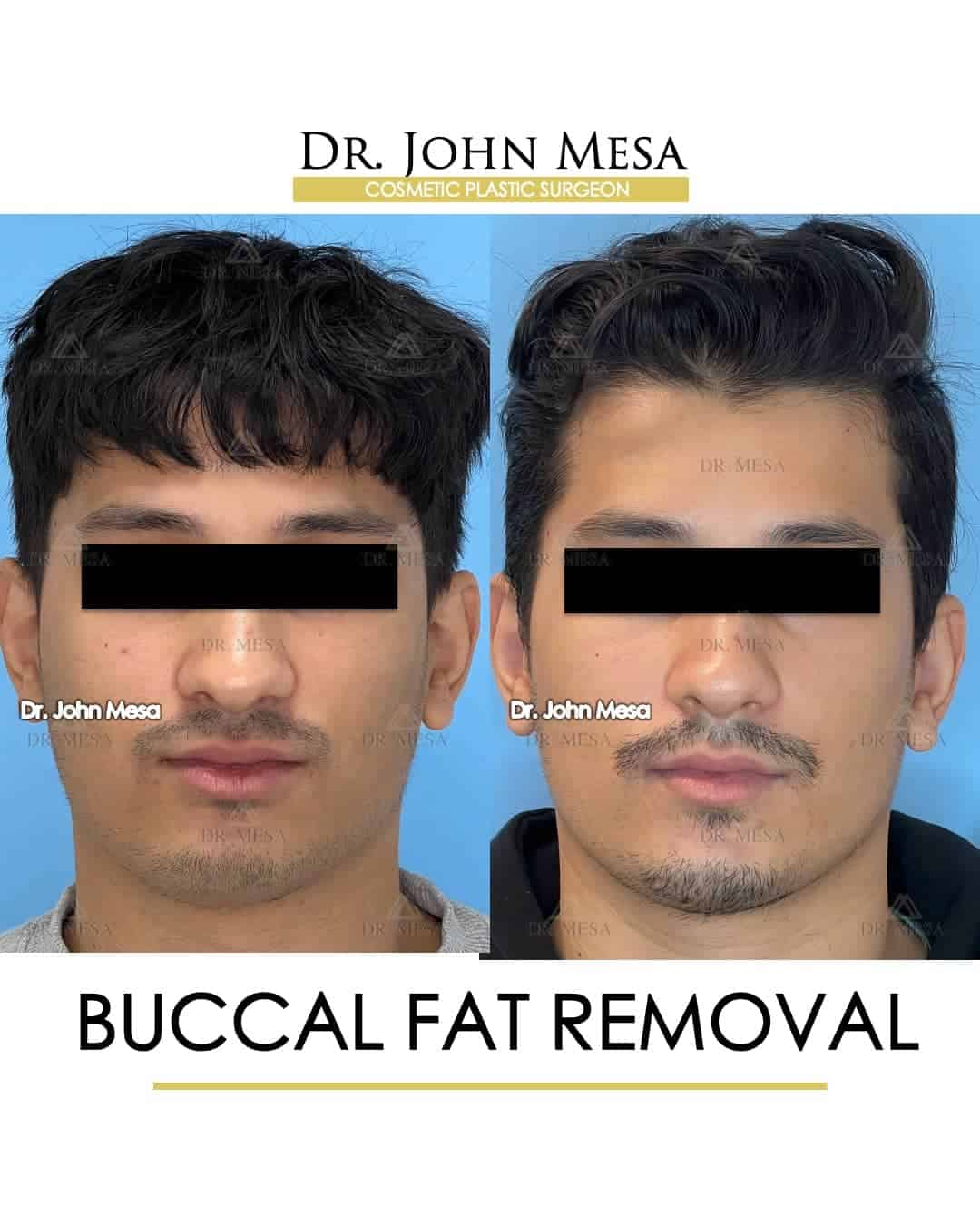 buccal fat removal treatment for men