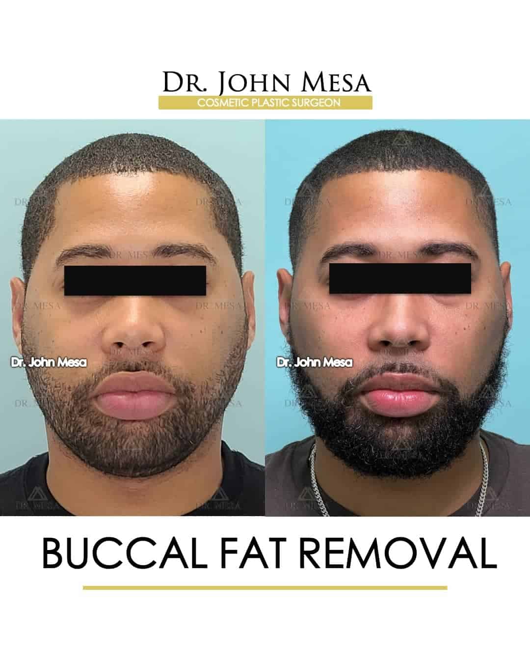 buccal fat removal in actors