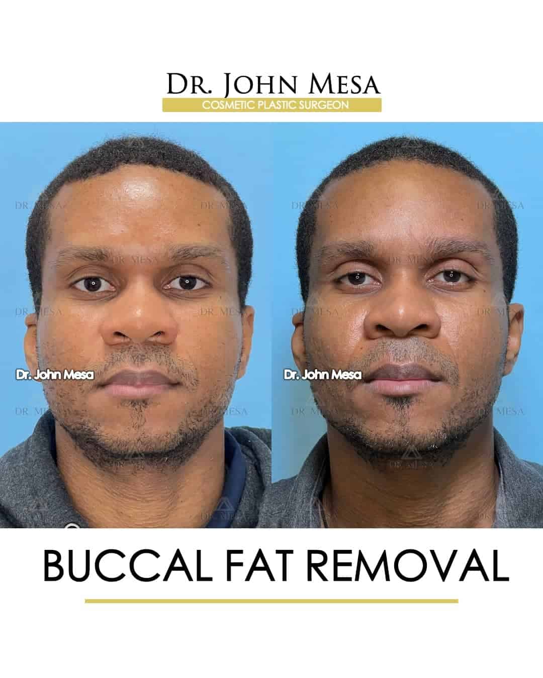 buccal fat removal in celebrities