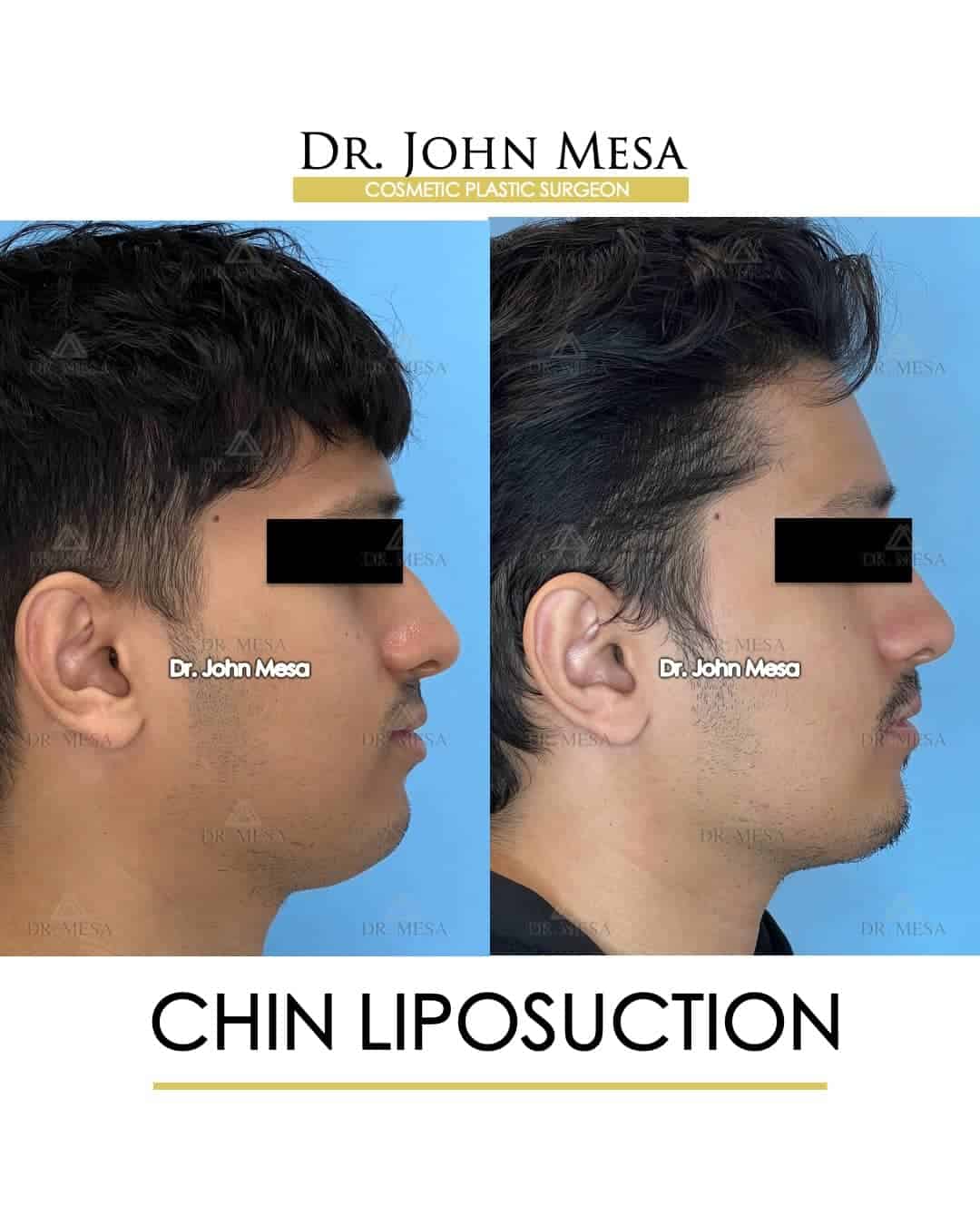 how expensive is chin liposuction