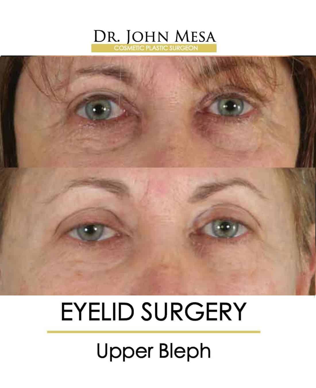 eyelid surgery nyc