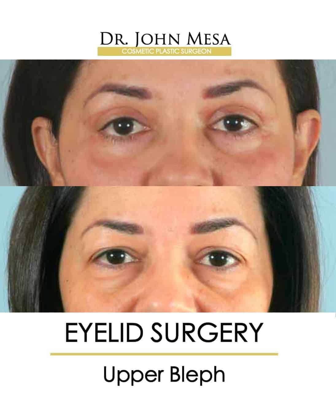 Eyelid Surgery NYC Before and After