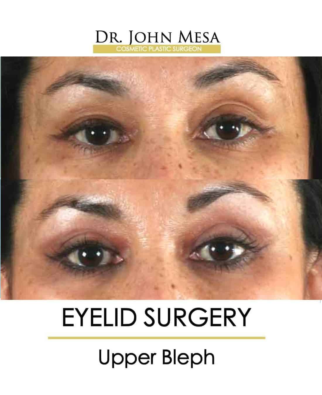 Eyelid Surgery NYC