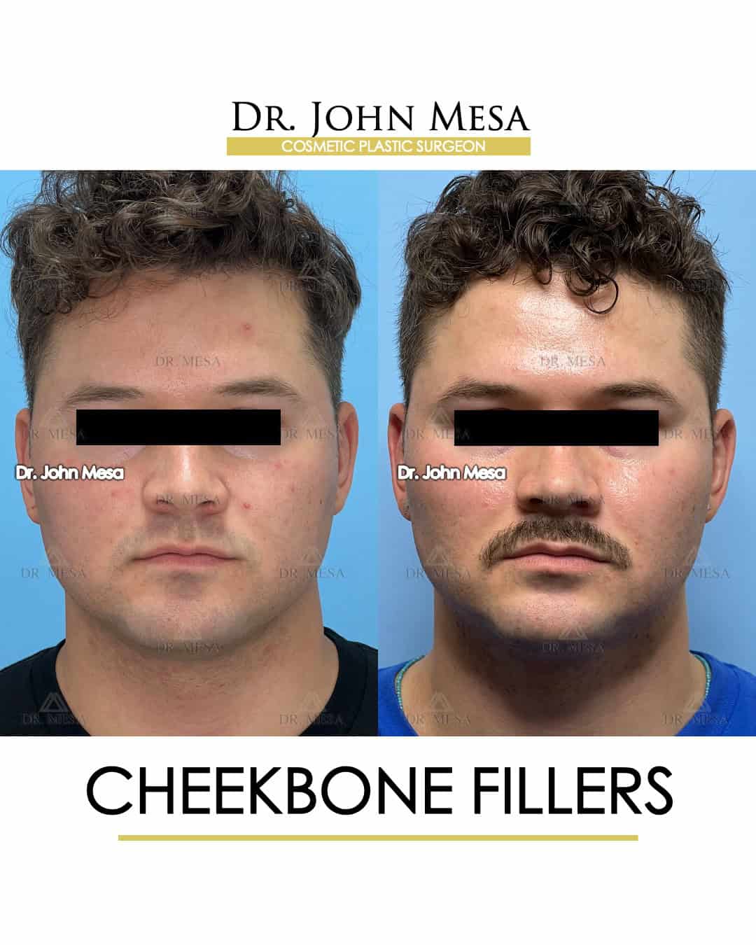 cheek face filler