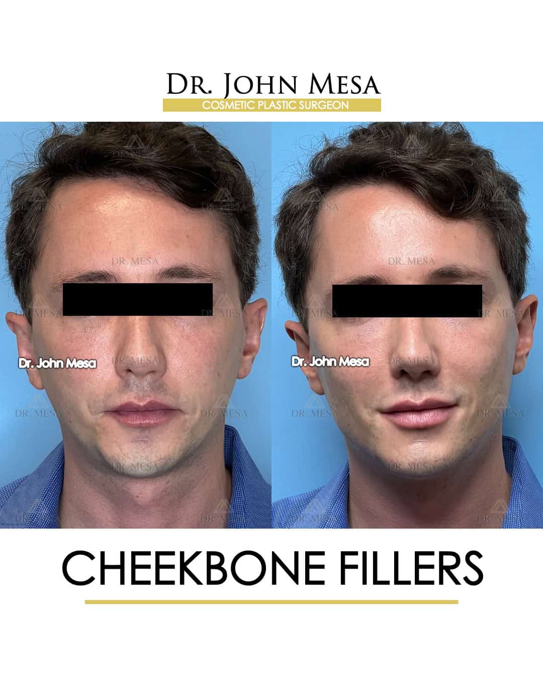 cheekbone fillers transformation