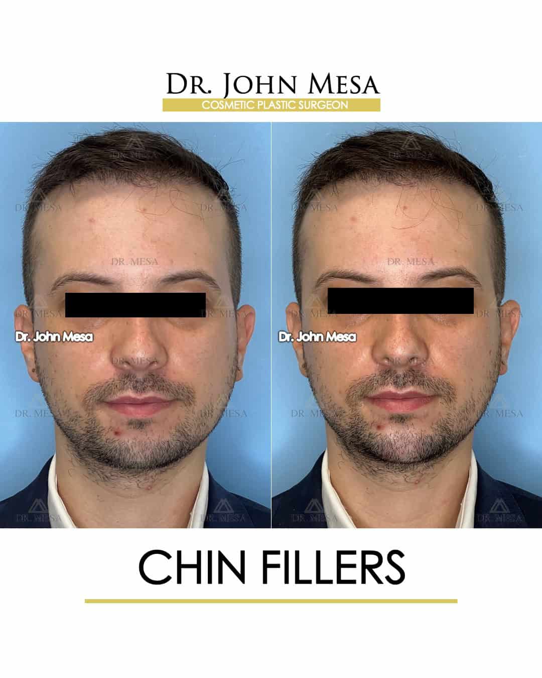 male celebrities with chin fillers before and afer