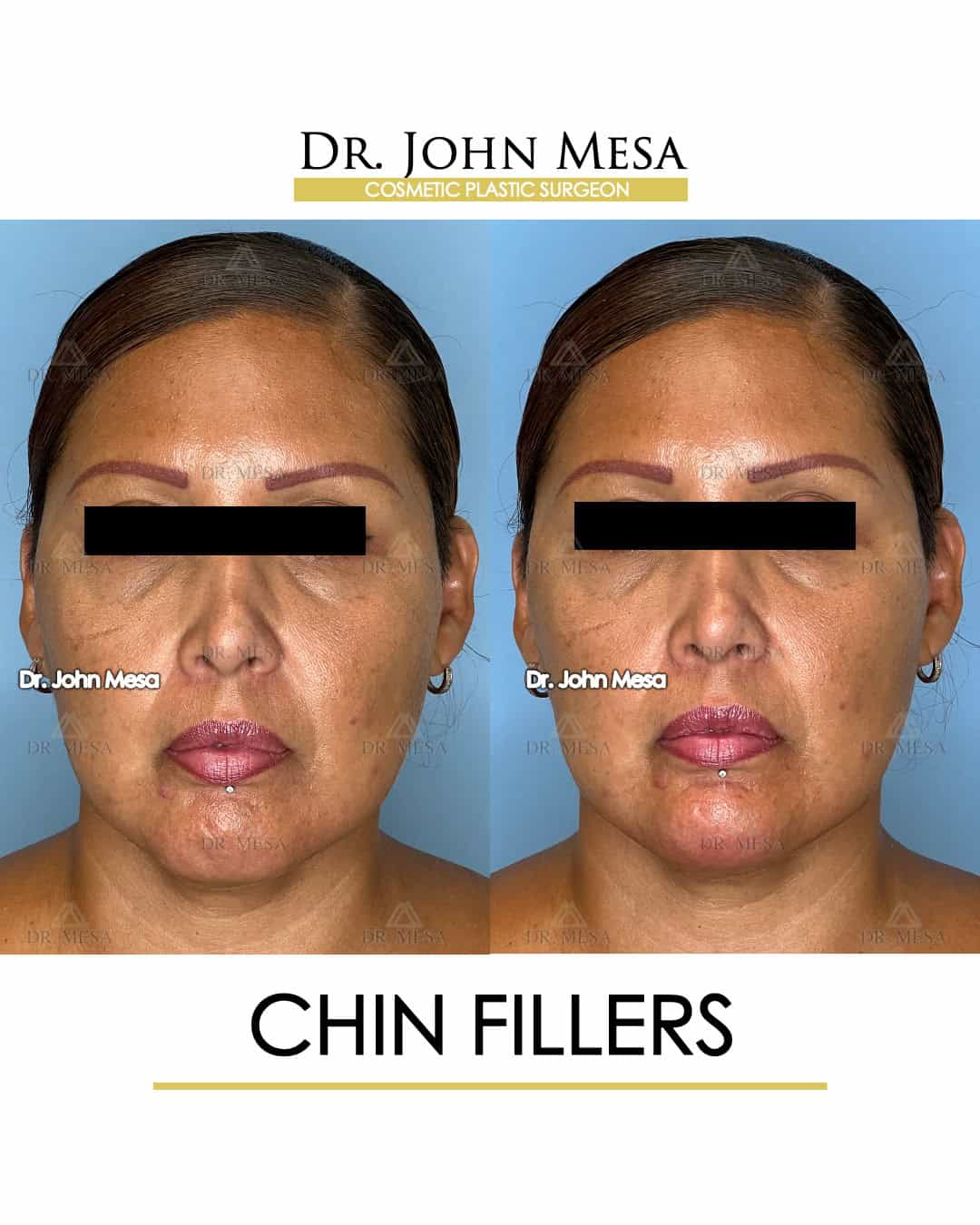 chin fillers doctor in miami