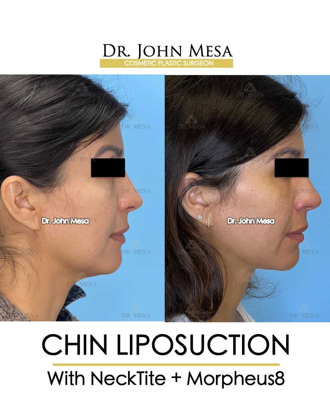Chin Liposuction NYC