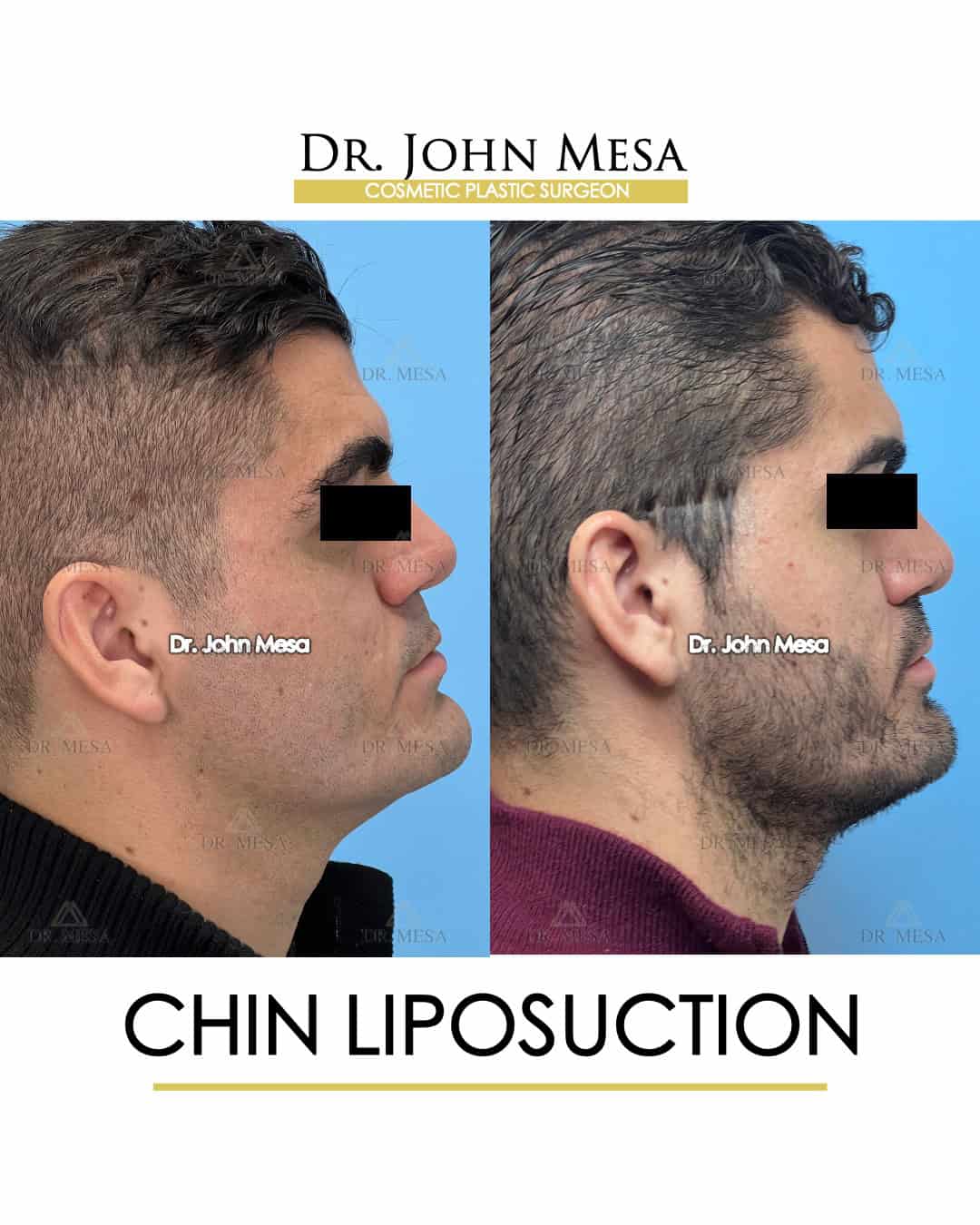 before and after photos chin liposuction for men