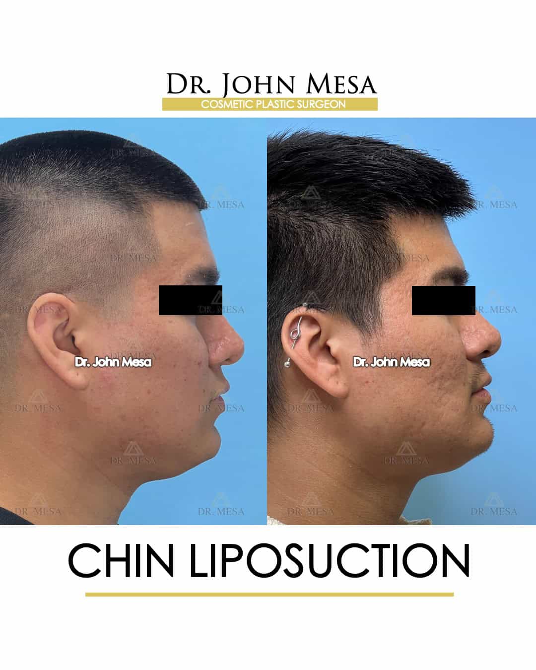 how much does chin liposuction cost