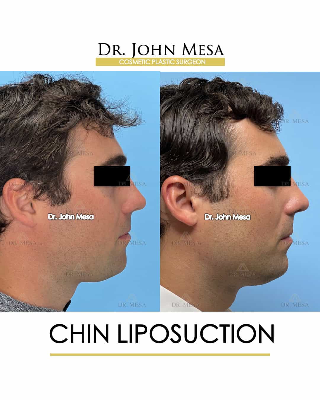 chin liposuction before after results photos