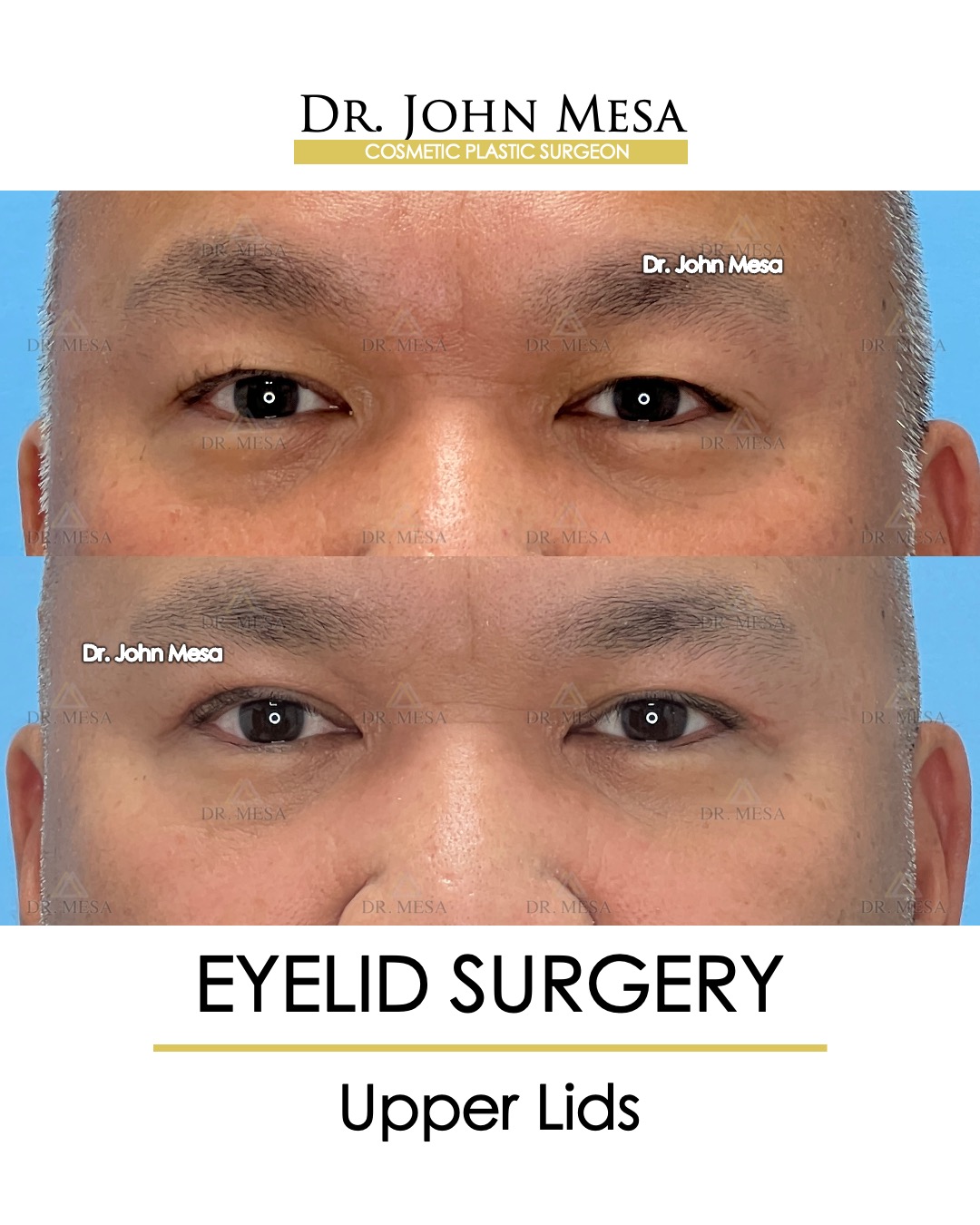 upper eyelid surgery before and after results