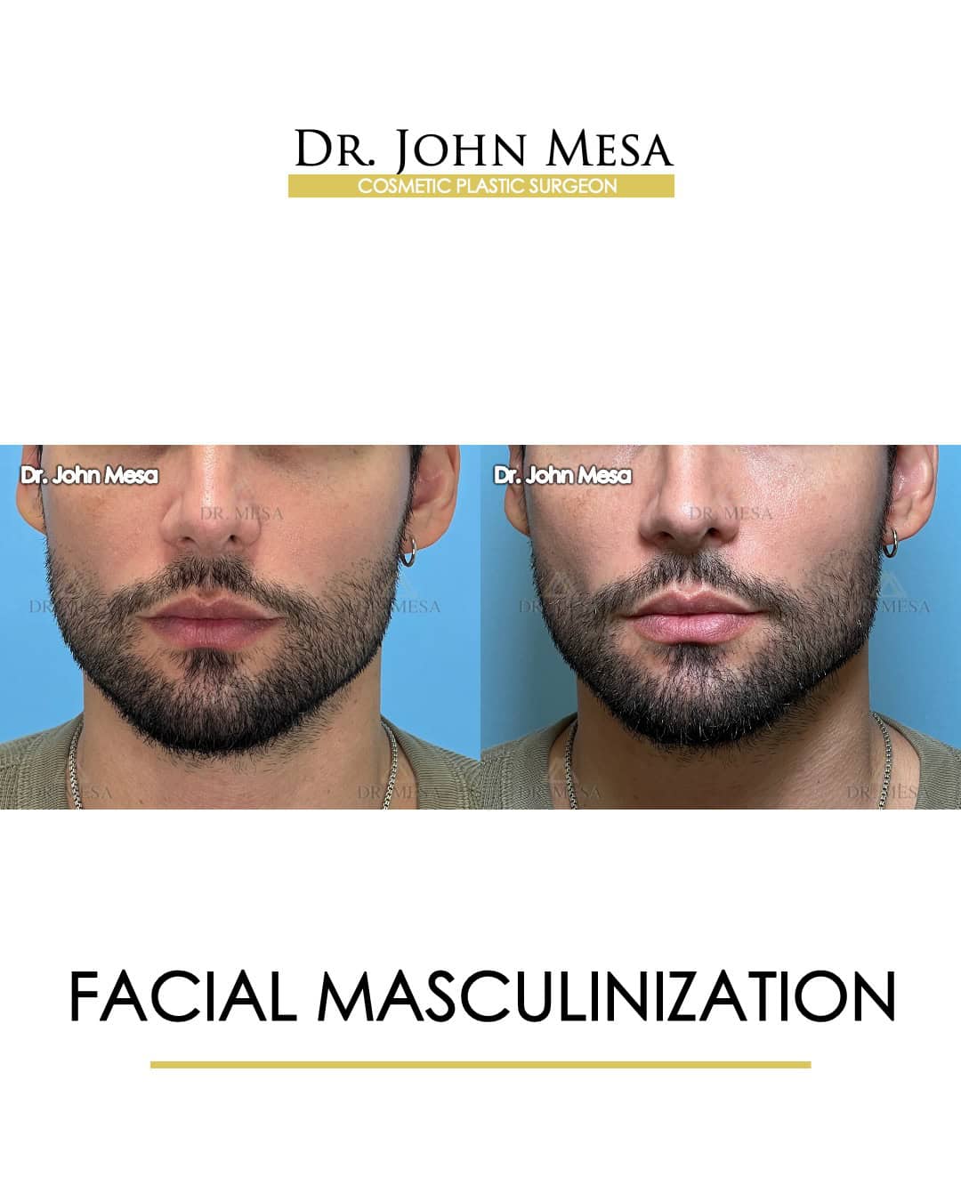 facial masculinization for men sample photos