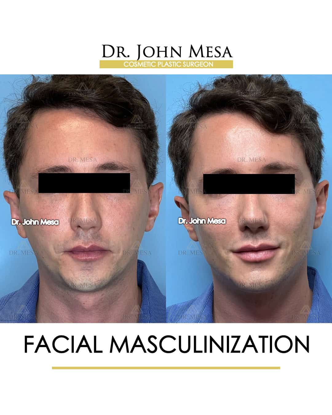 facial masculinization before and after results
