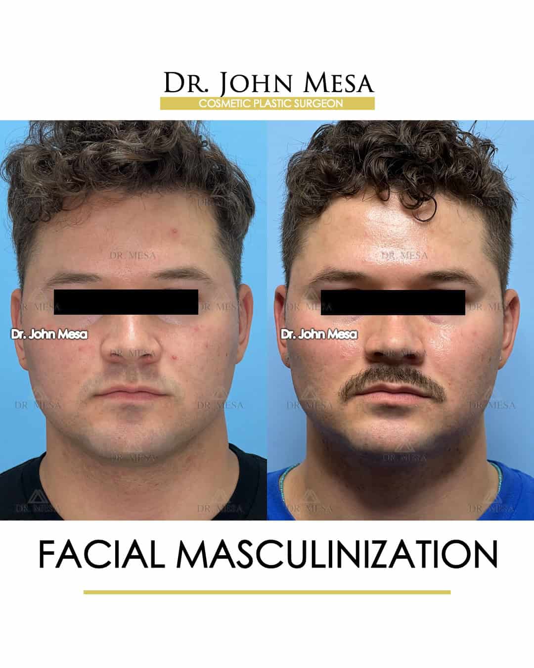 best facial masculinization surgeon