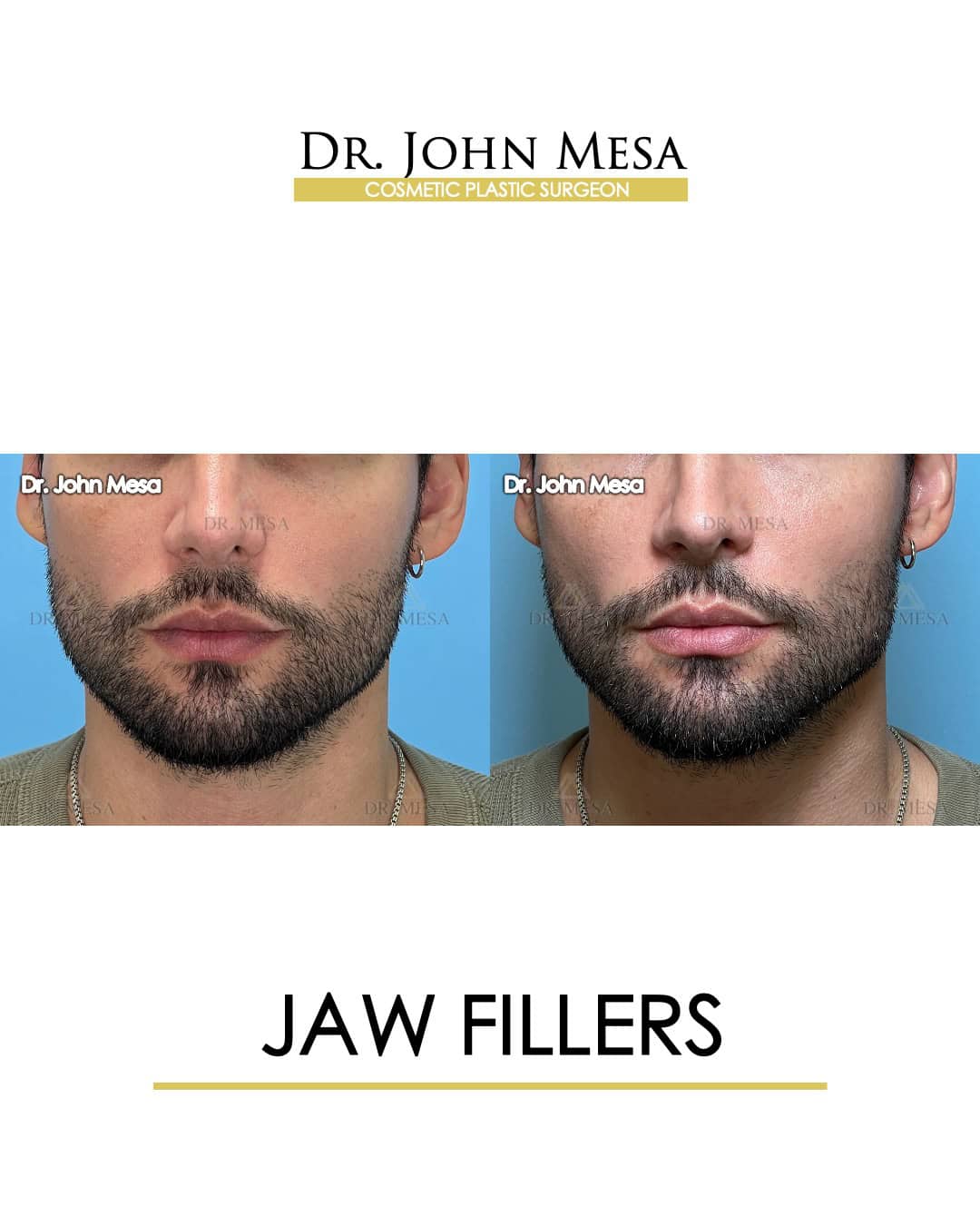men jawline contouring surgery fillers