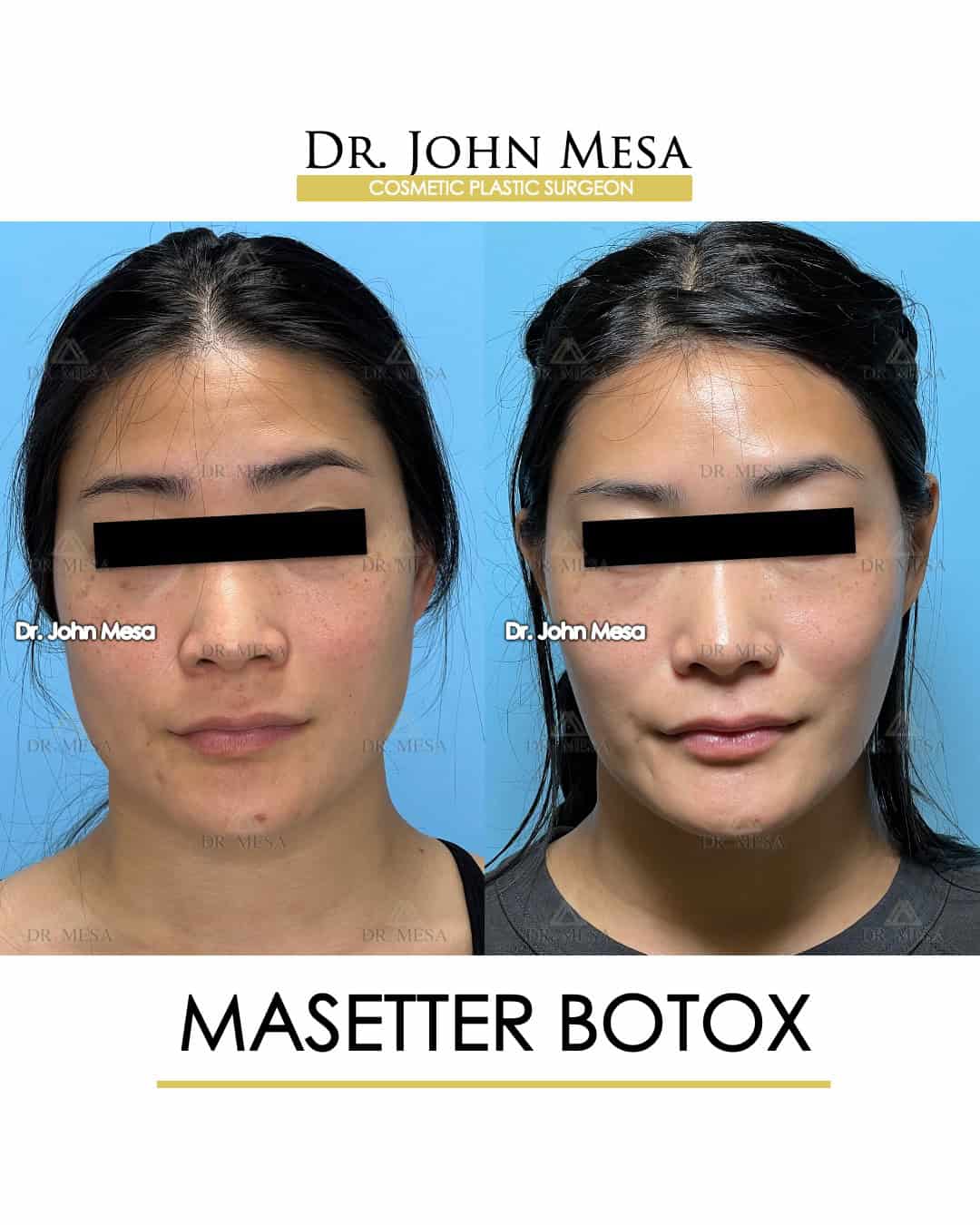 how much is masseter botox in nyc