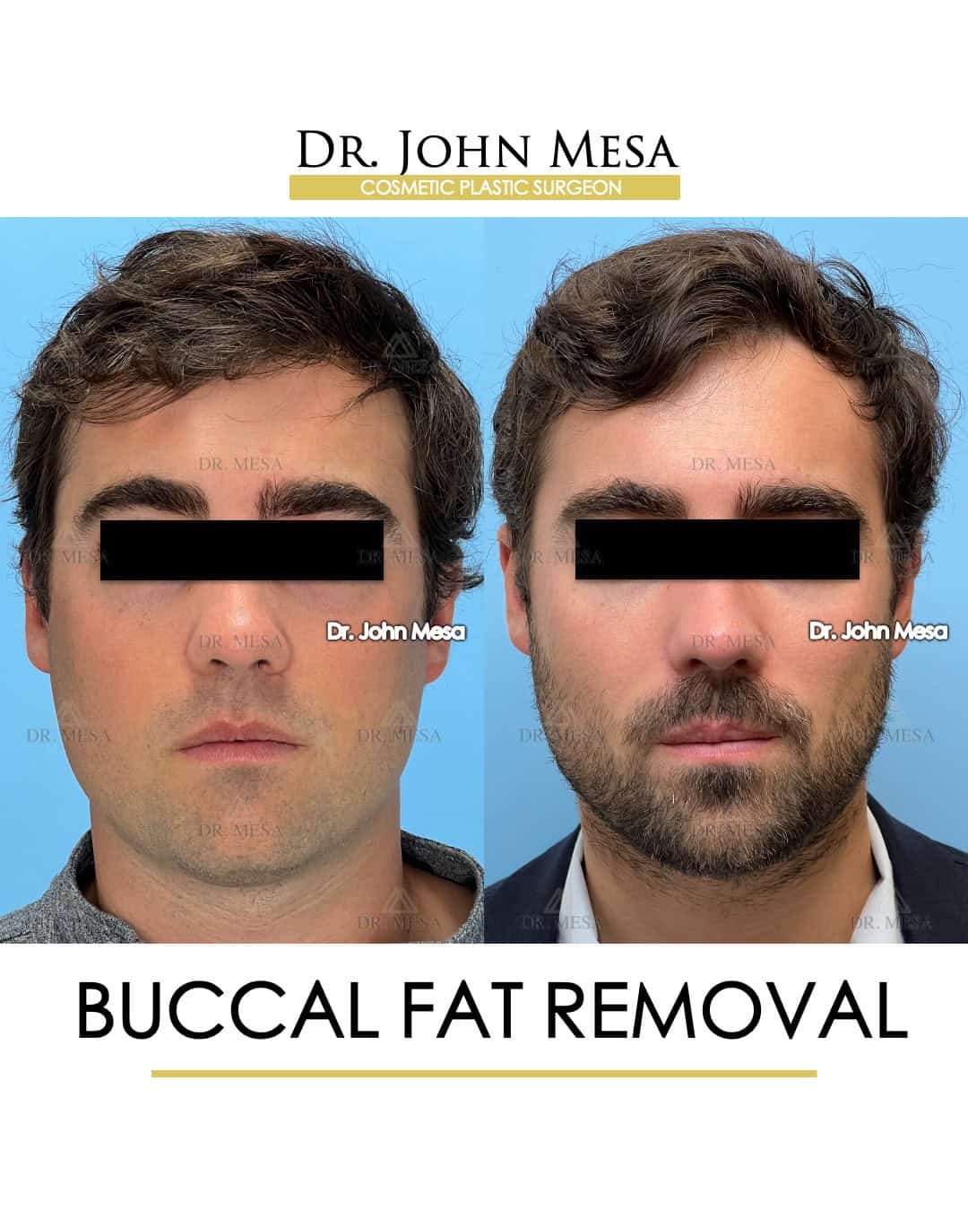 buccal fat removal for face