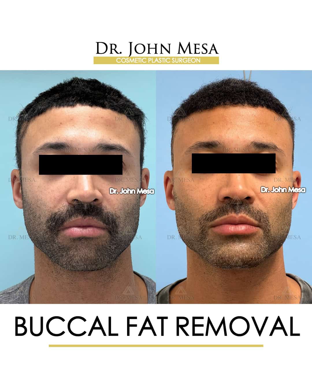 buccal fat removal asian transformation