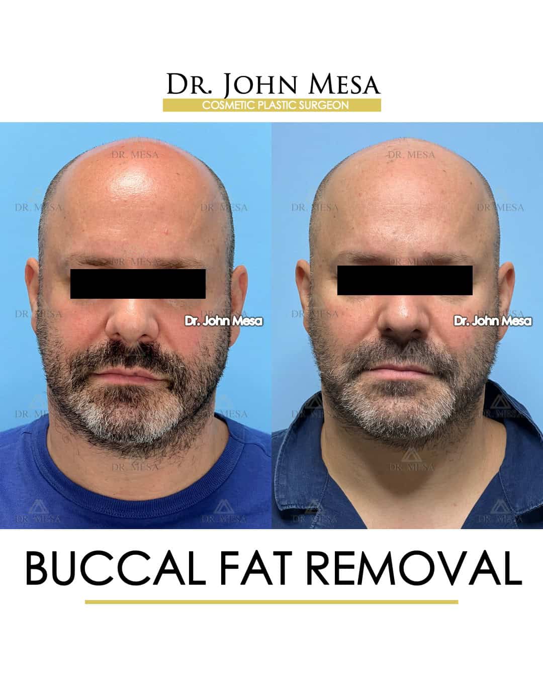 buccal fat removal before after patient images