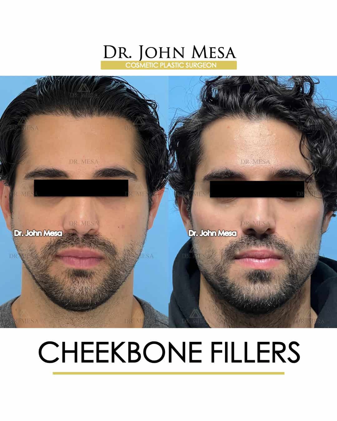 chubby cheeks for men