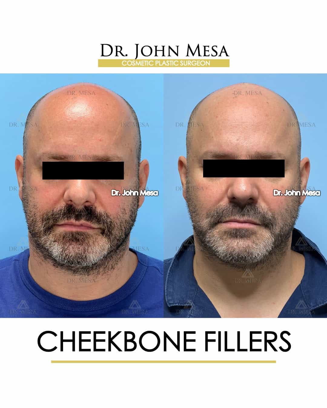 fatty cheekbones surgery for men