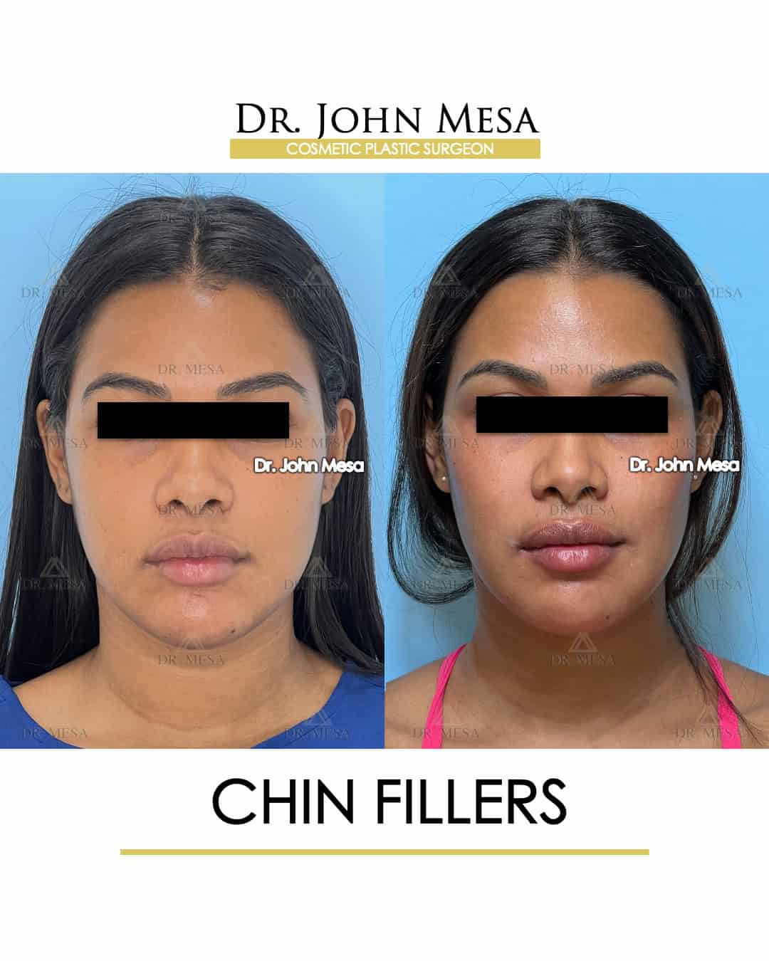 chin fillers pictures