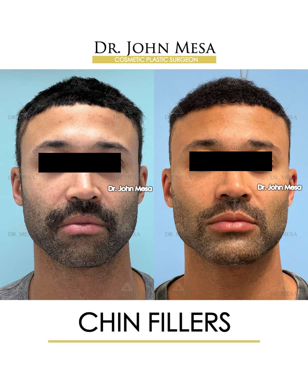 how much do chin fillers cost