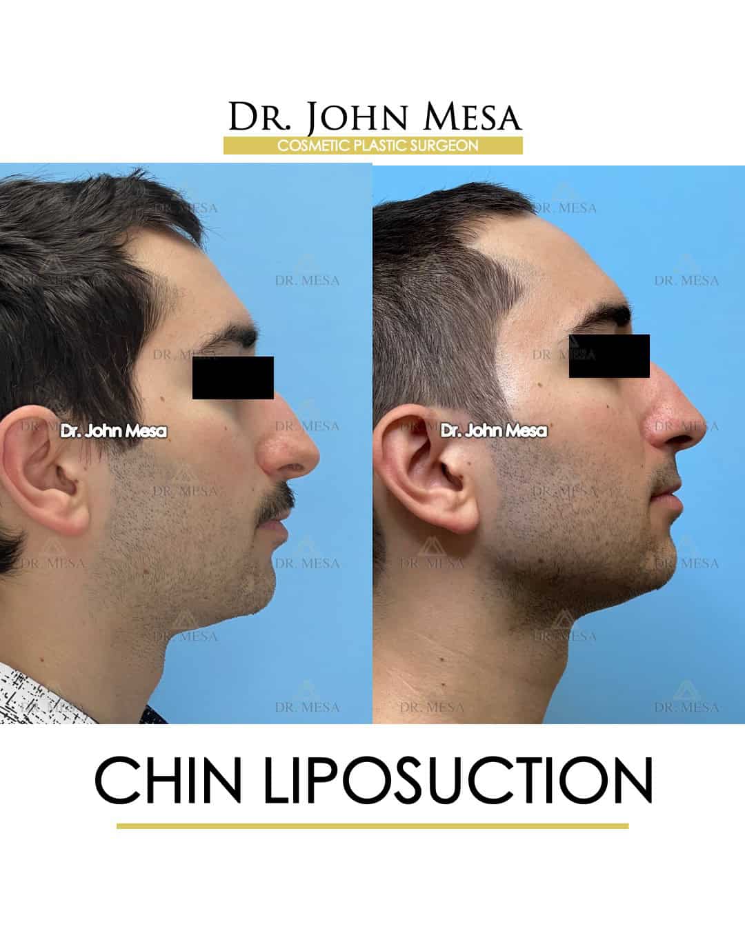 chin liposuction doctor reviews
