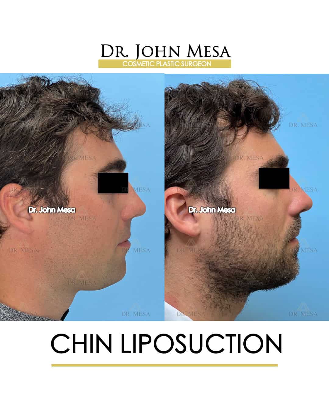 male celebrities with chin liposuction done