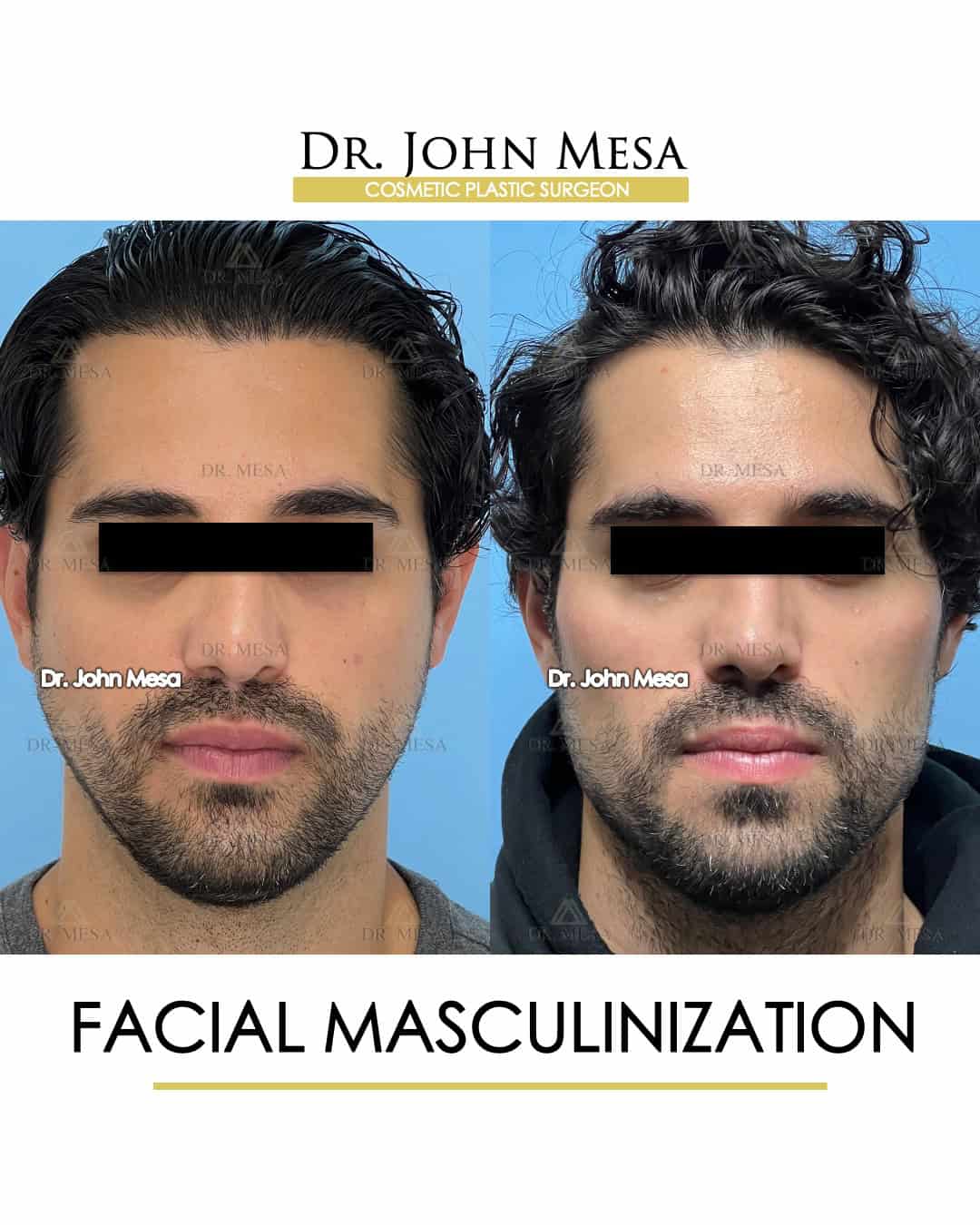 facial masculinization surgery near me cost
