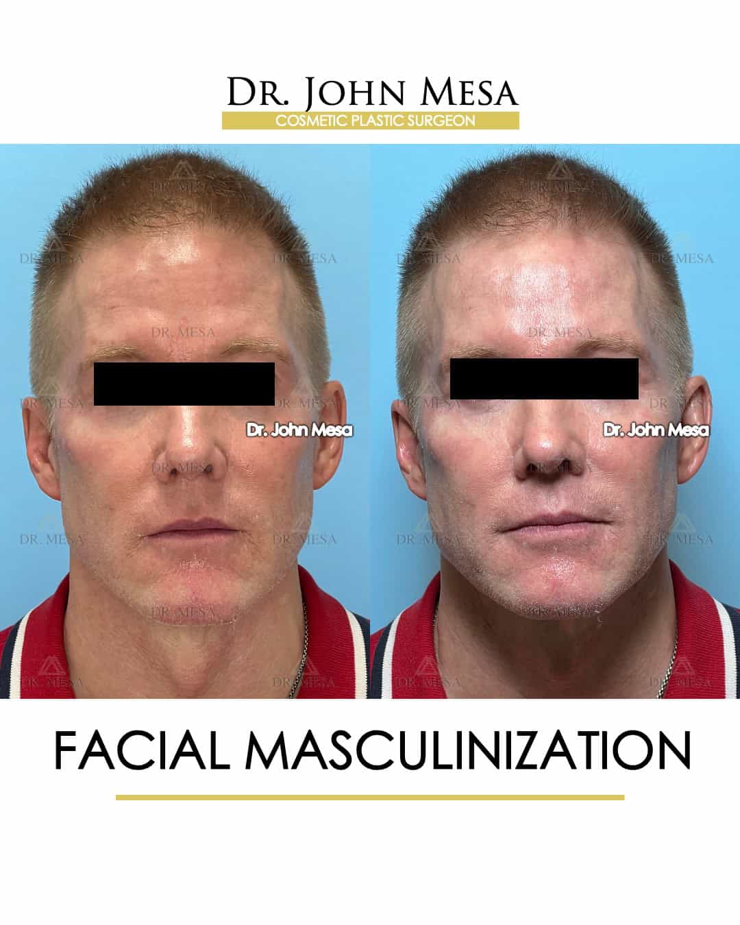 facial masculinization fillers surgery
