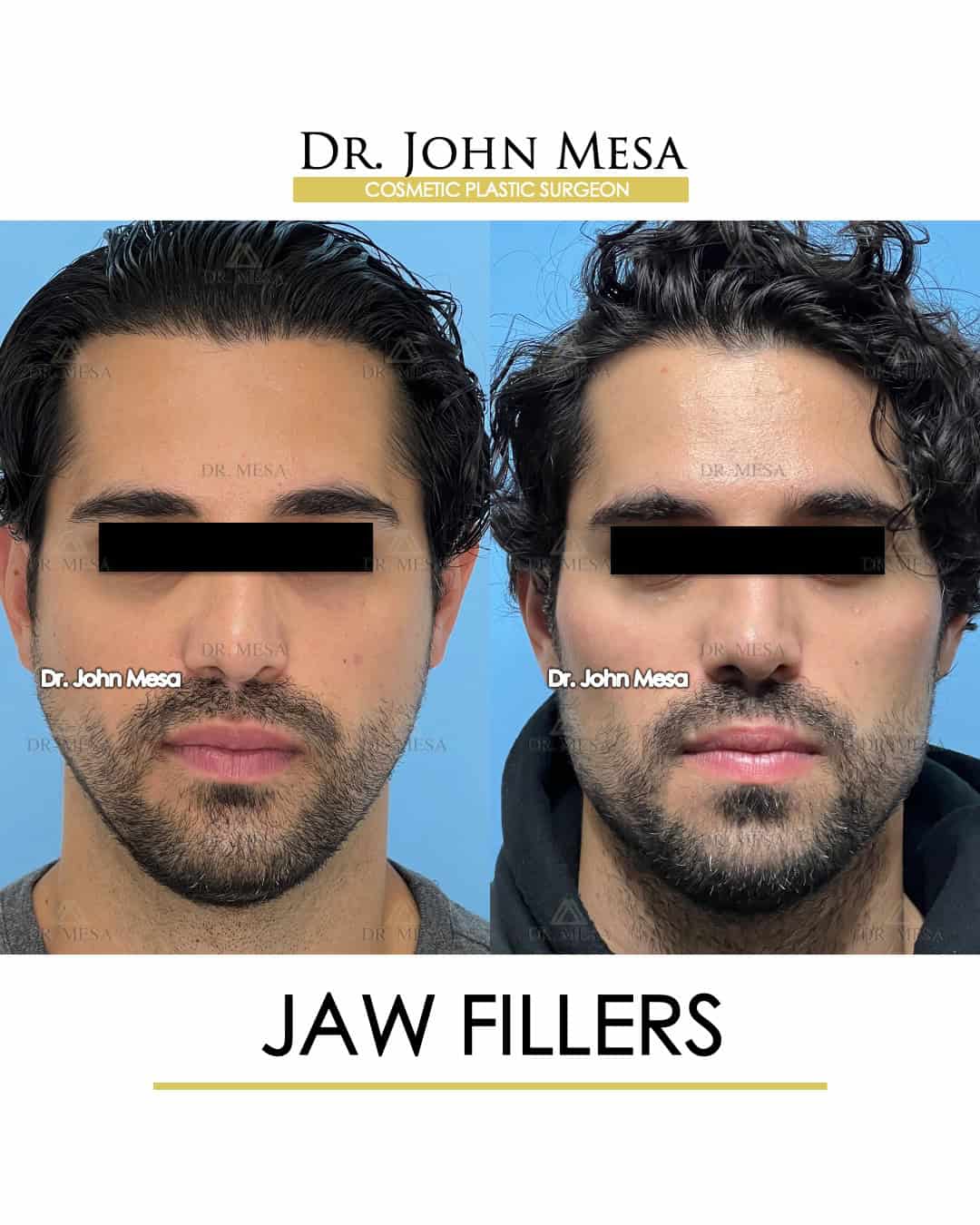 jaw fillers new york city miami new jersey