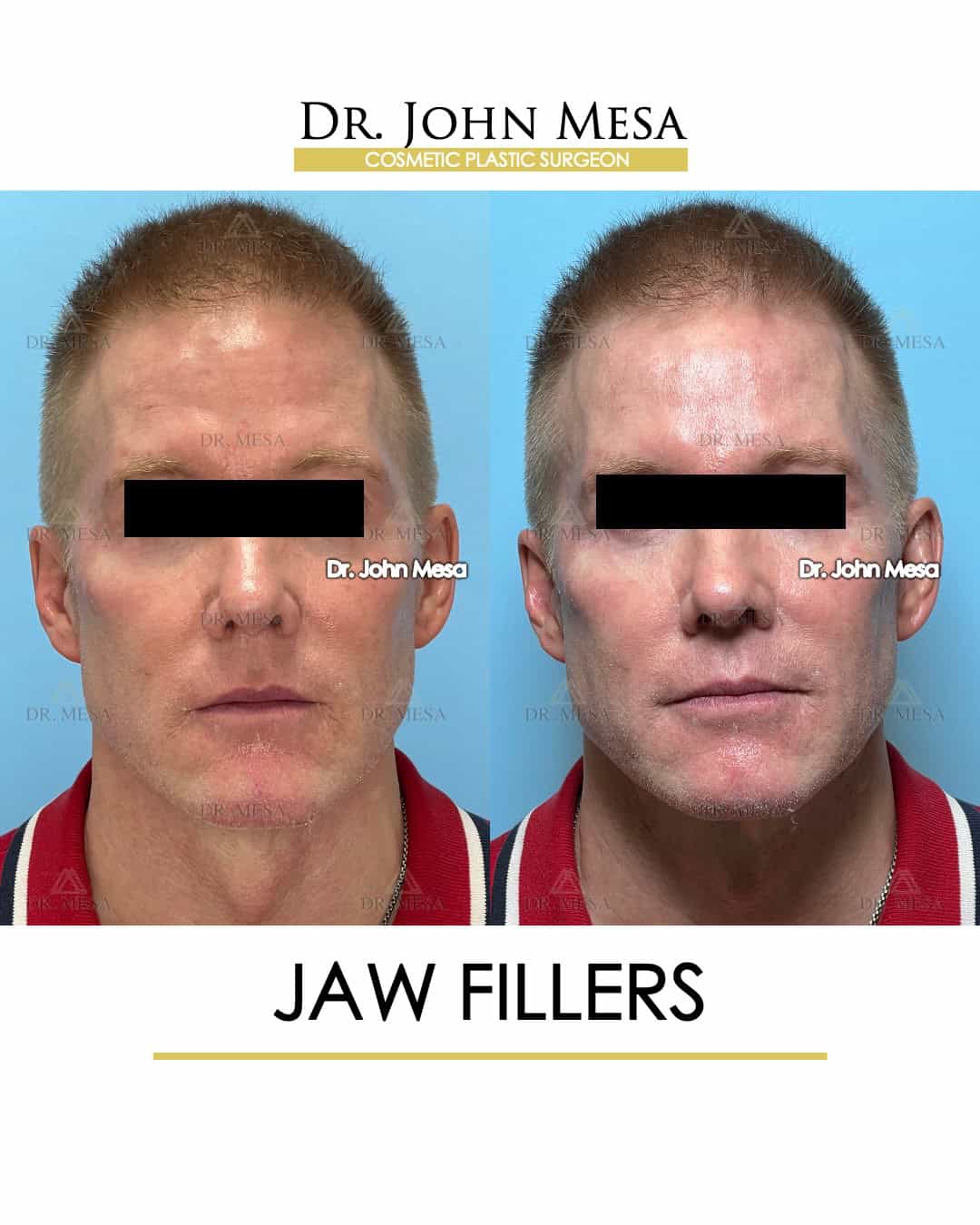 before and after photos jaw fillers surgery for men