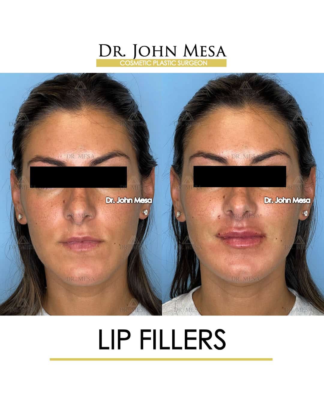 lip-fillers-cost-in-nyc