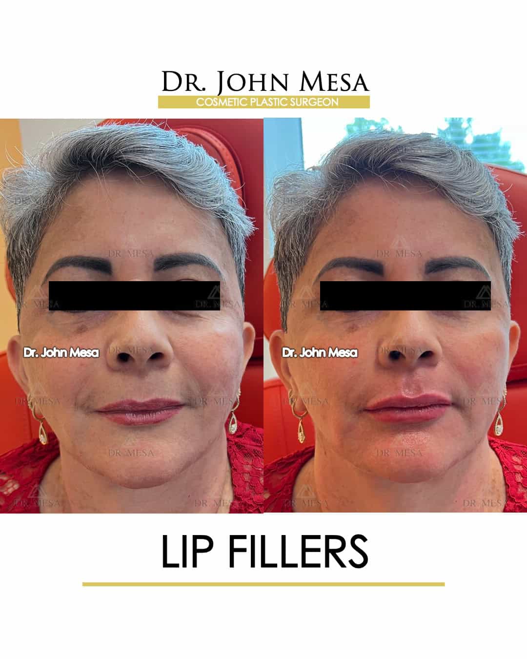 how-much-is-lip-filler-nyc