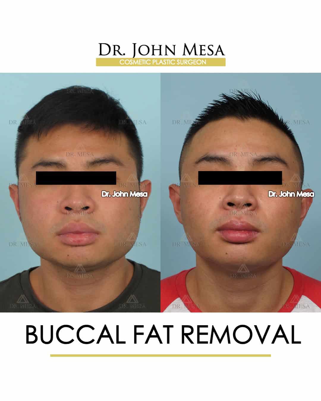 buccal fat removal before after surgery results