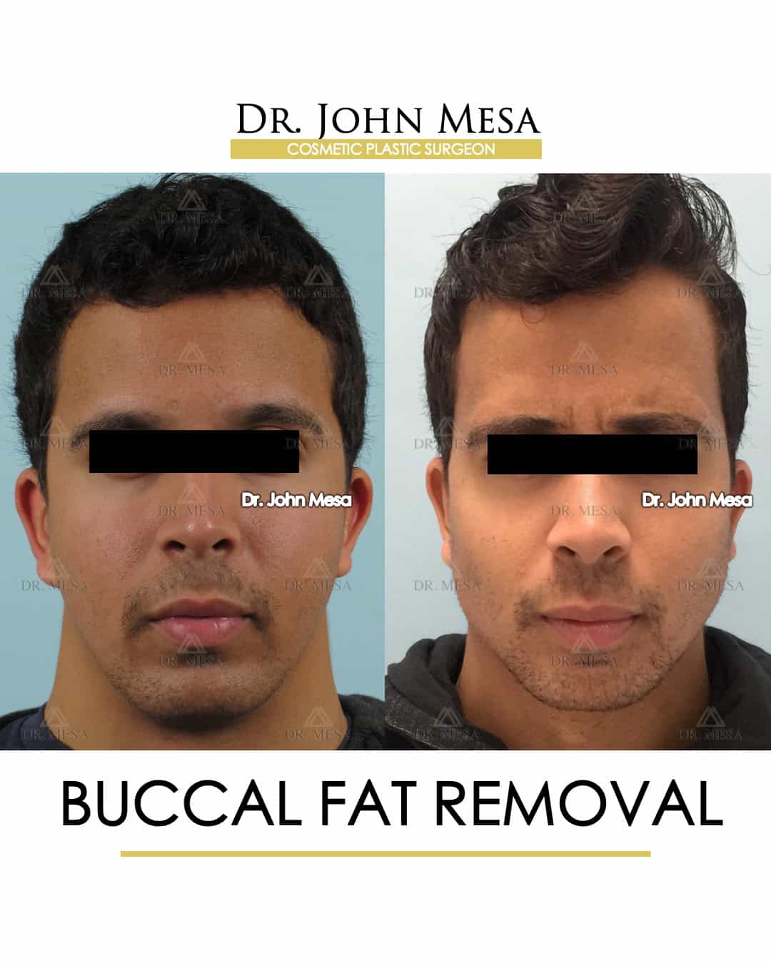 is buccal fat removal surgery for men cheap